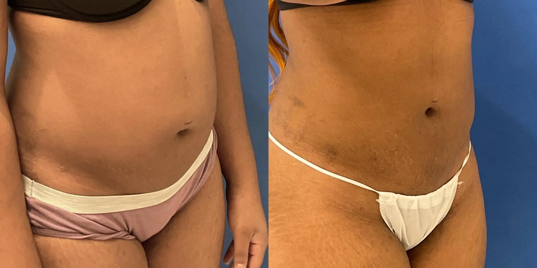 Liposuction: Patient 10 - Before and After 3