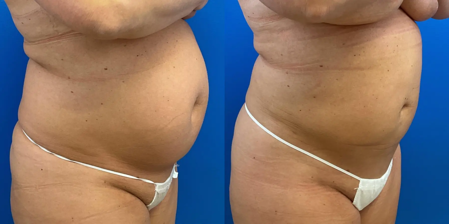 Before and after a liposuction. - Before and After 3