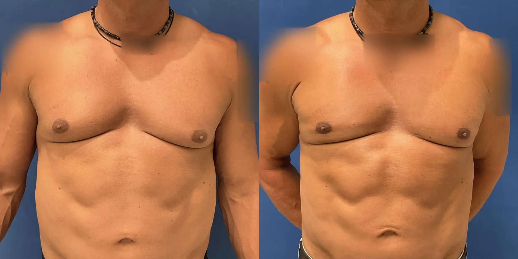 Liposuction For Men: Patient 2 - Before and After 1