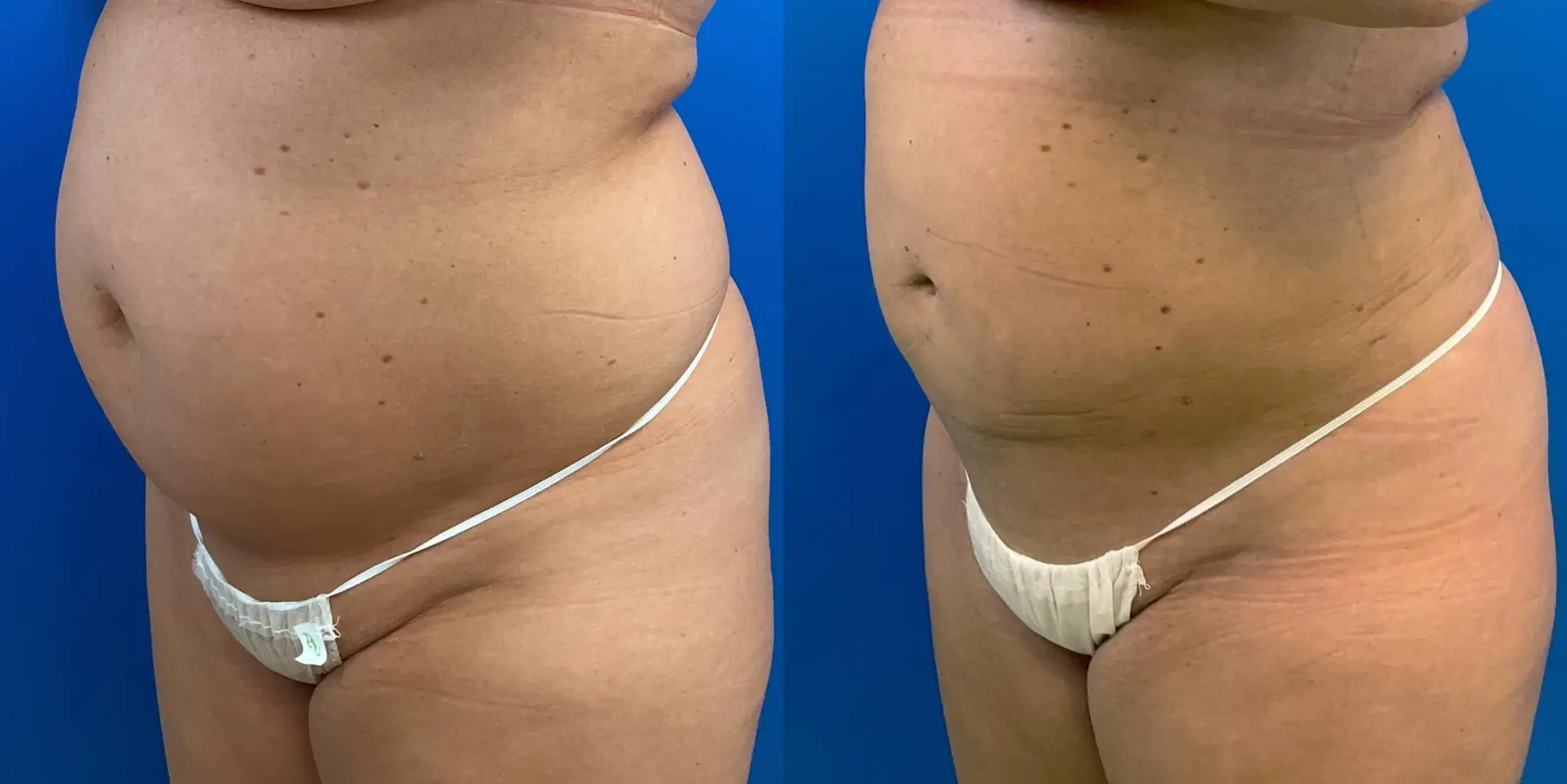 Before and after a liposuction. - Before and After 2