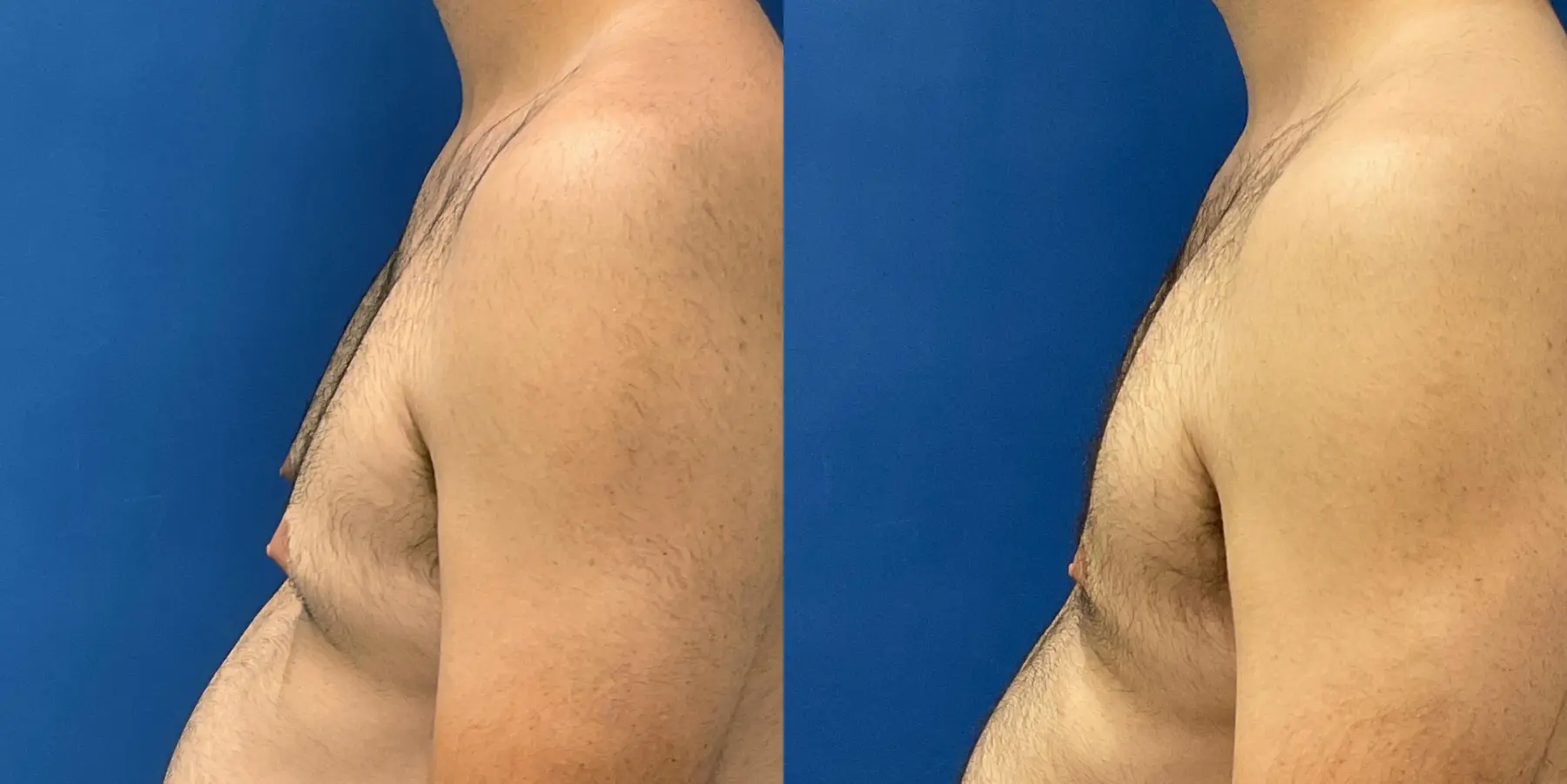 Liposuction For Men: Patient 3 - Before and After 4