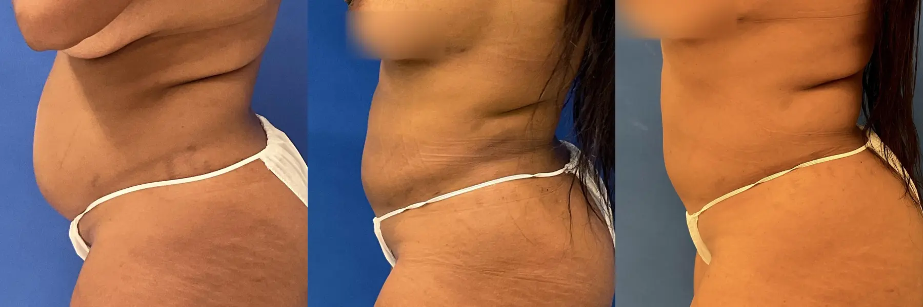 Liposuction: Patient 11 - Before and After 4