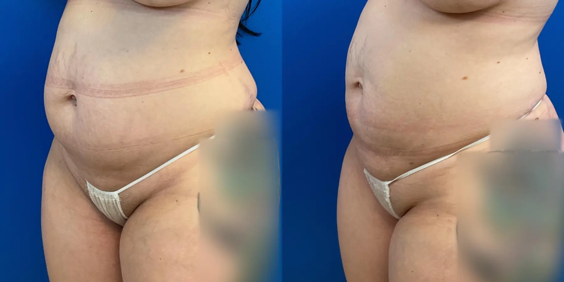 Before and after a liposuction. - Before and After 2