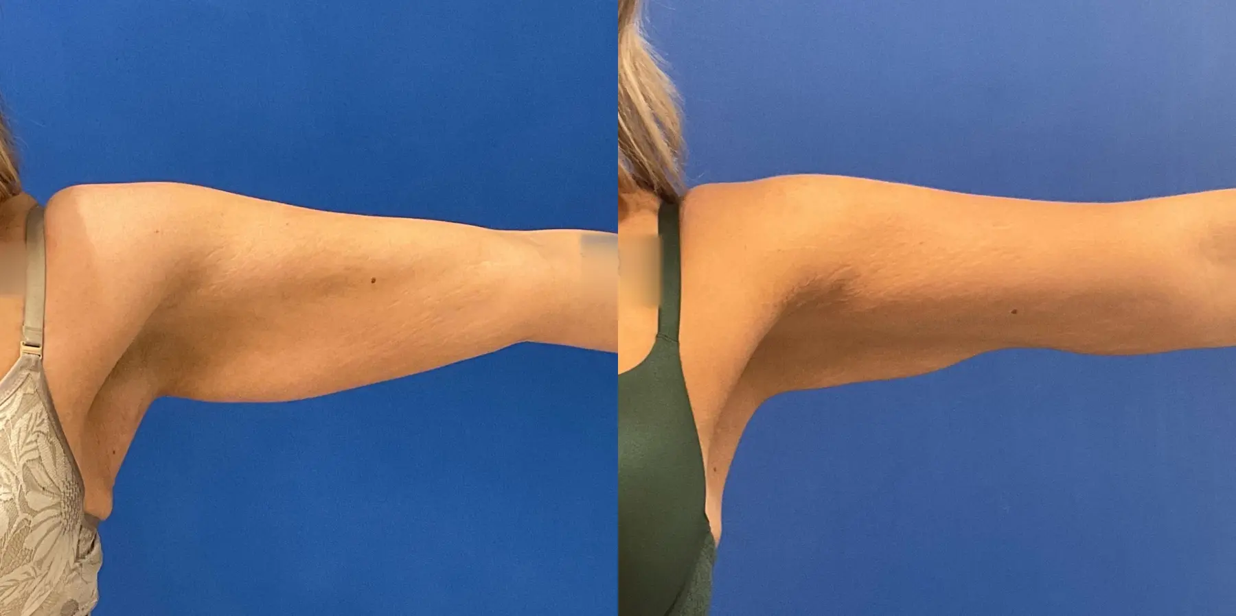 Liposuction: Patient 21 - Before and After 1