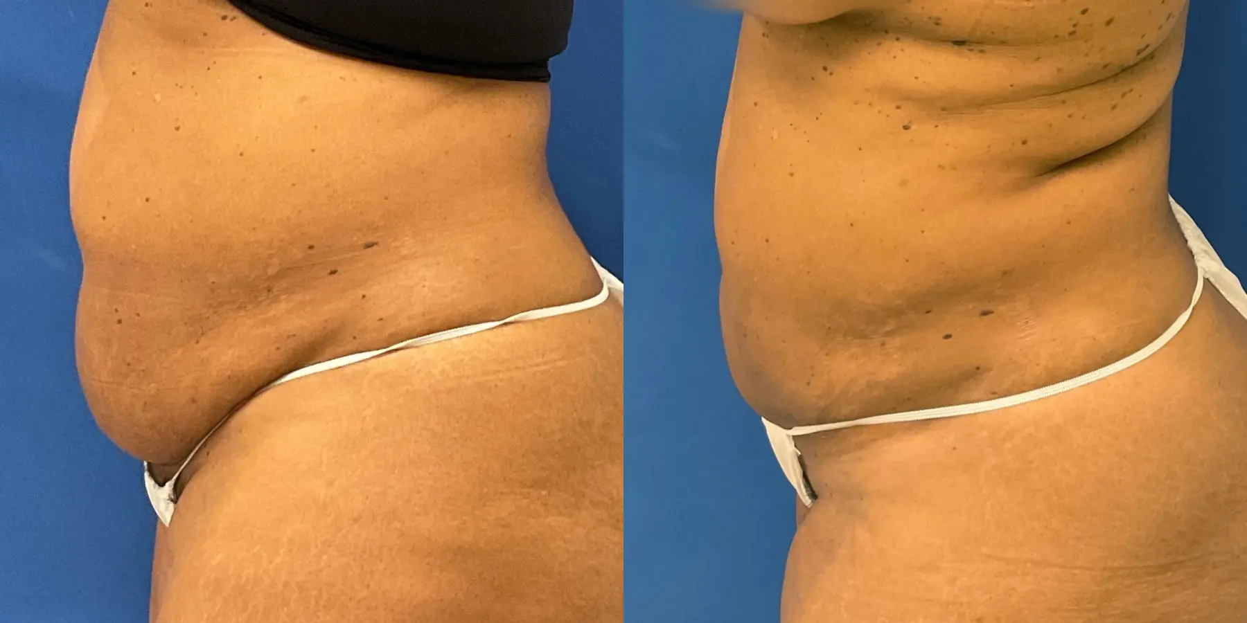 Liposuction: Patient 6 - Before and After 4