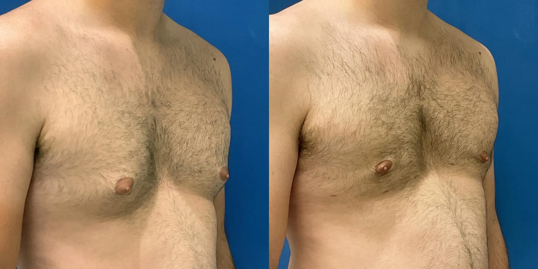 Liposuction For Men: Patient 6 - Before and After 3