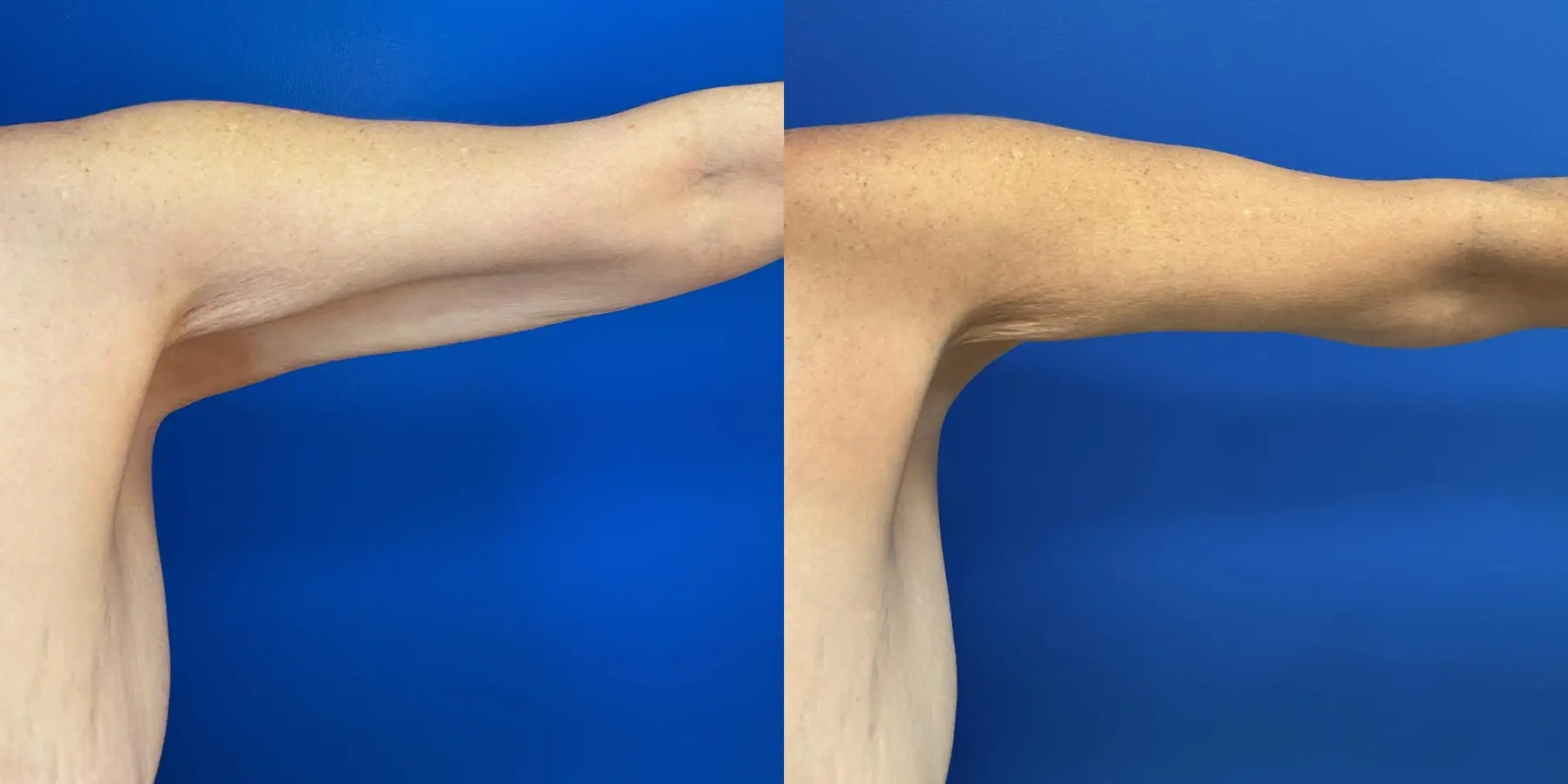 Liposuction: Patient 4 - Before and After 6