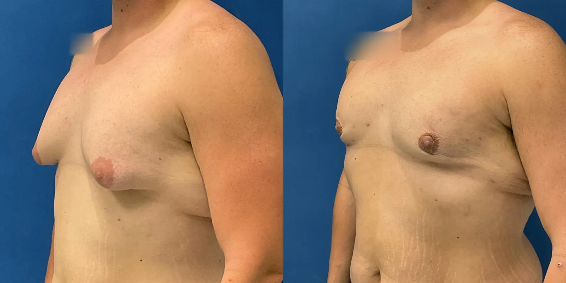 Liposuction For Men: Patient 4 - Before and After 2