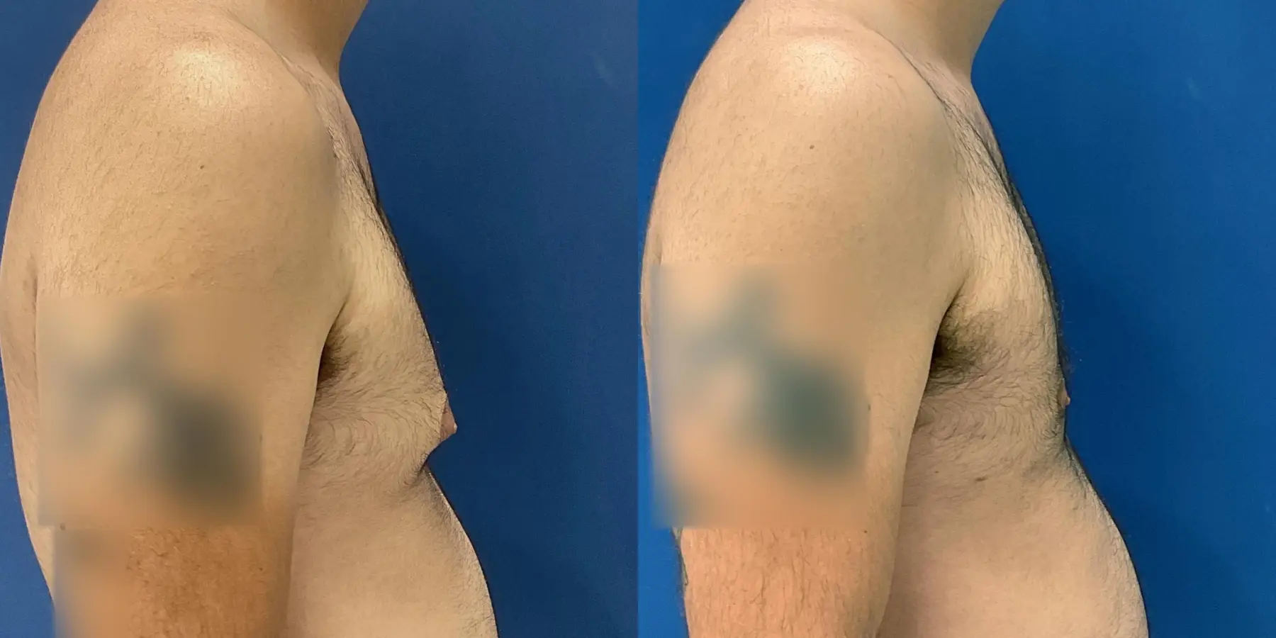 Liposuction For Men: Patient 6 - Before and After 5