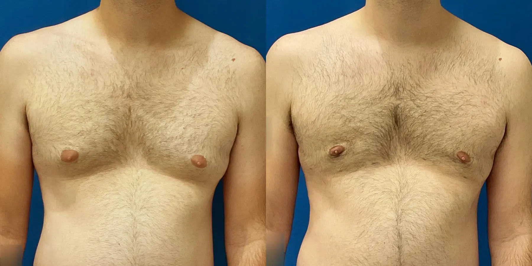 Liposuction For Men: Patient 6 - Before and After 1