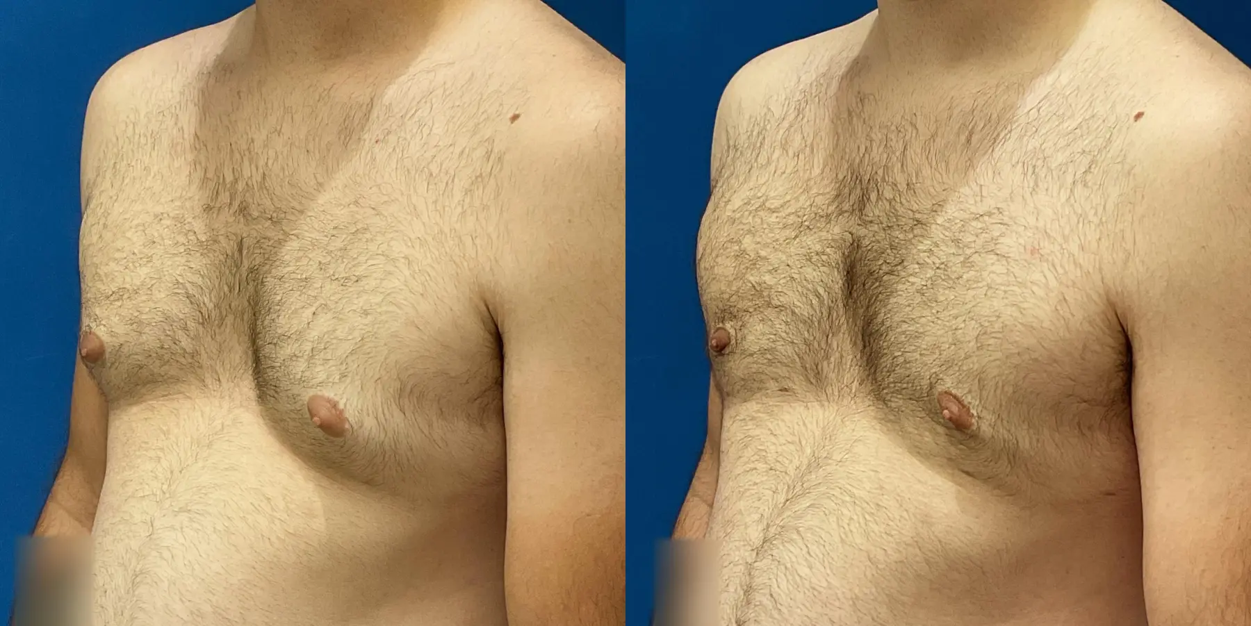 Liposuction For Men: Patient 6 - Before and After 2