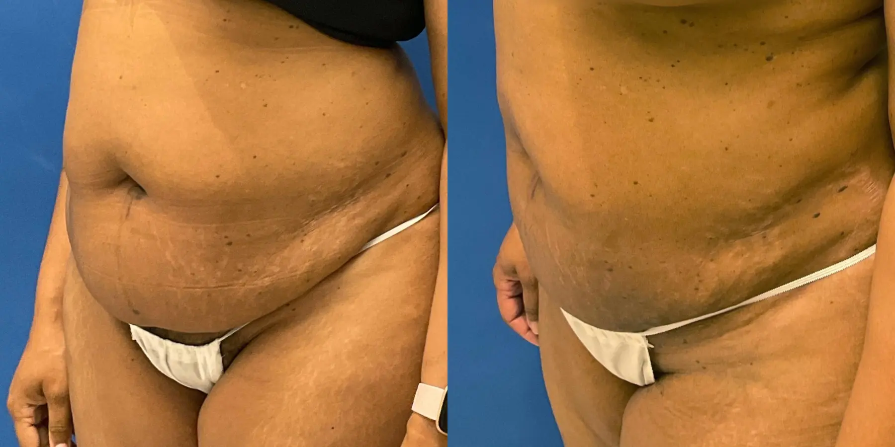 Liposuction: Patient 6 - Before and After 2