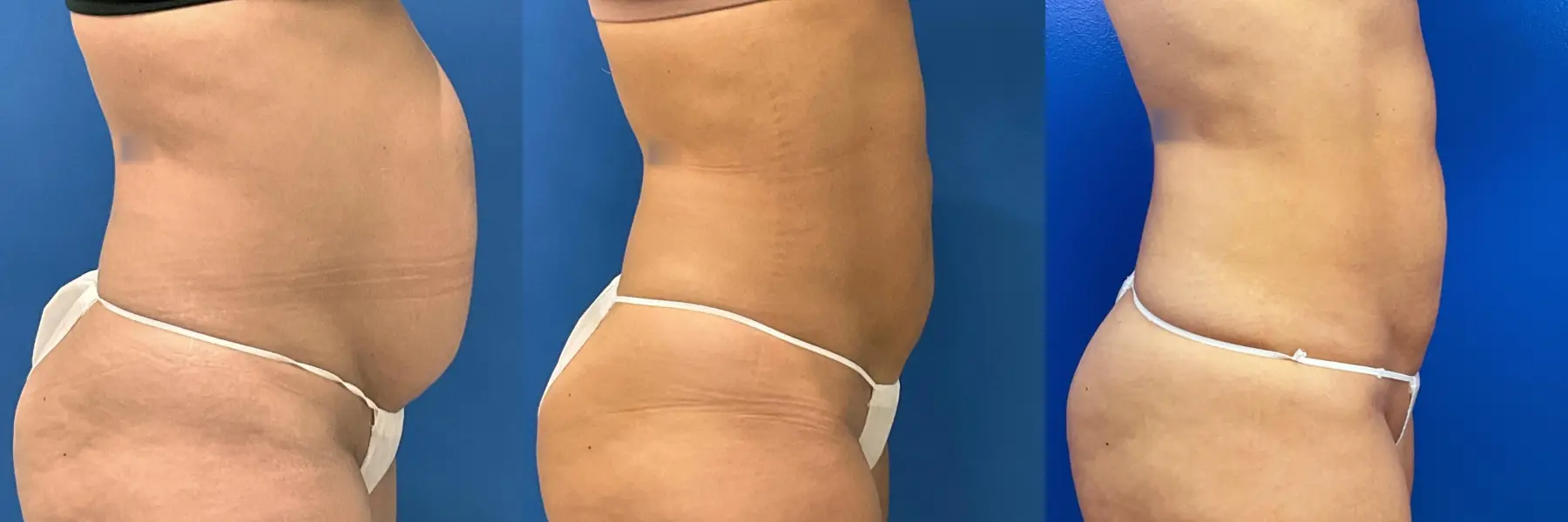 Liposuction: Patient 18 - Before and After 5