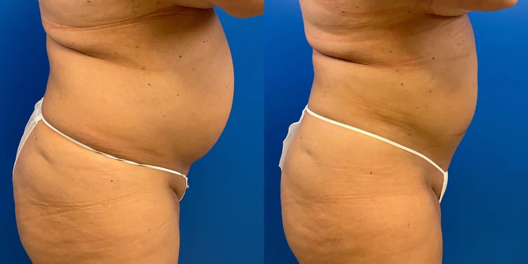 Before and after a liposuction. - Before and After 5