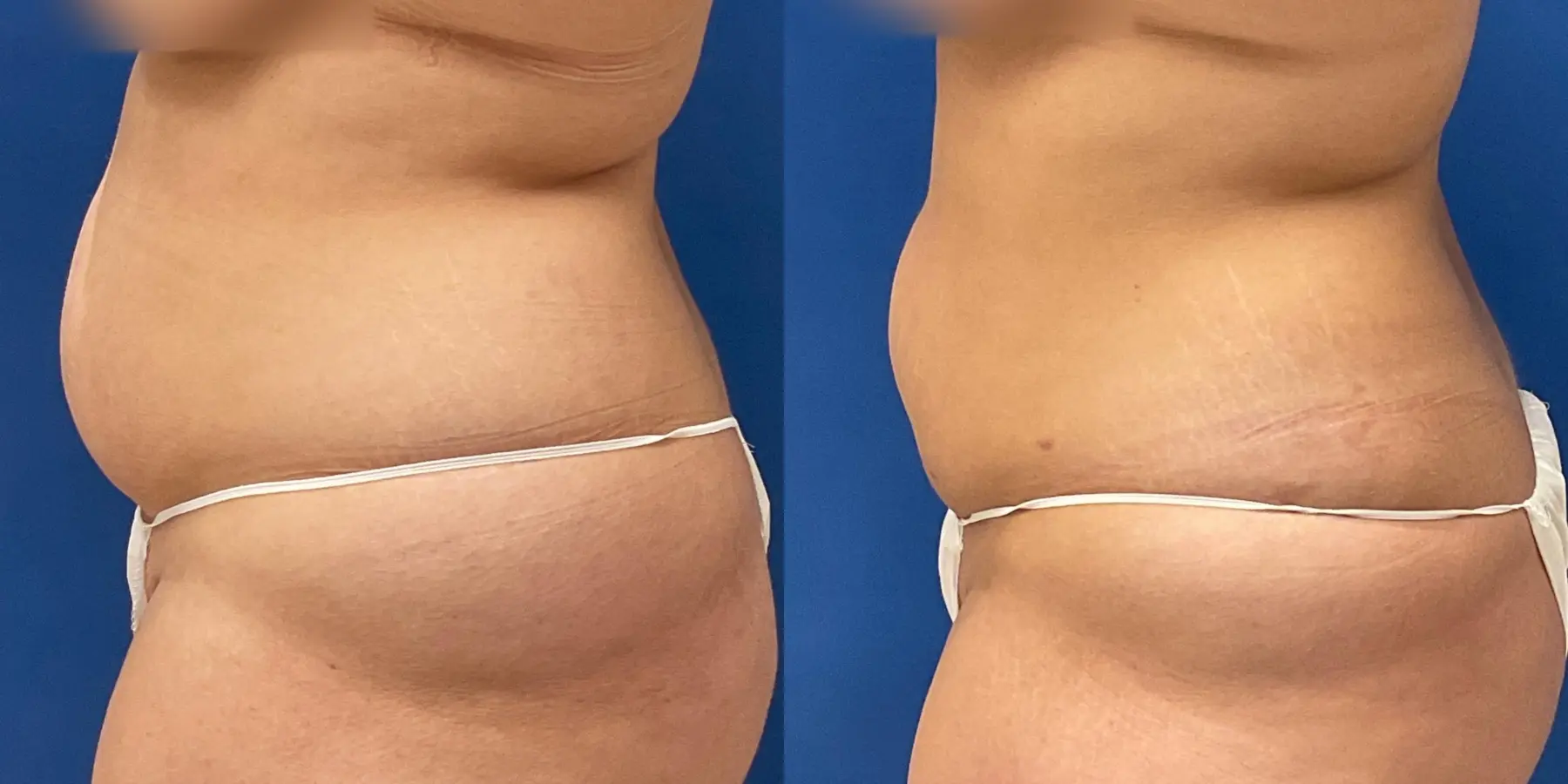 Before and after a liposuction. - Before and After 4