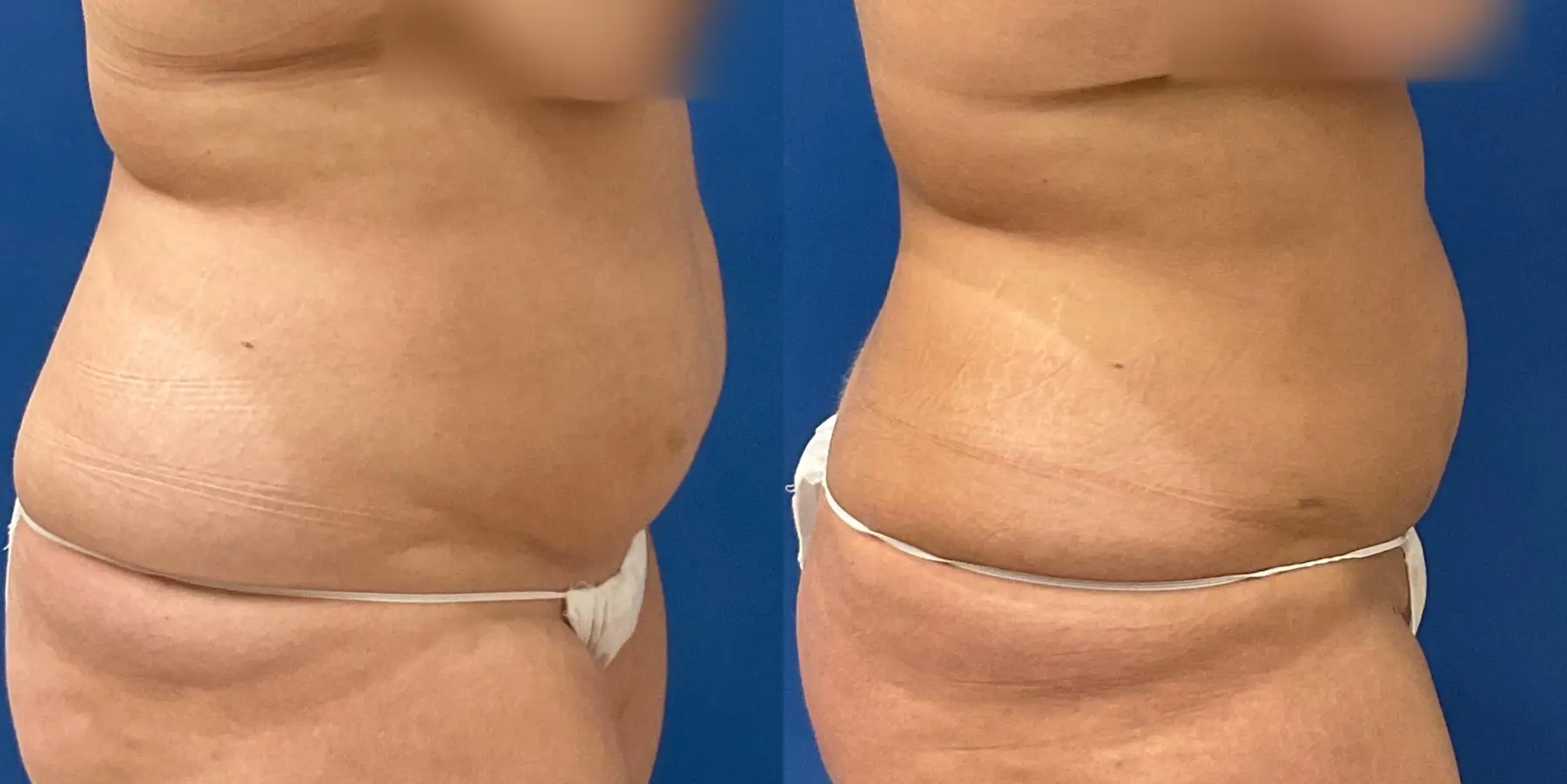 Before and after a liposuction. - Before and After 5