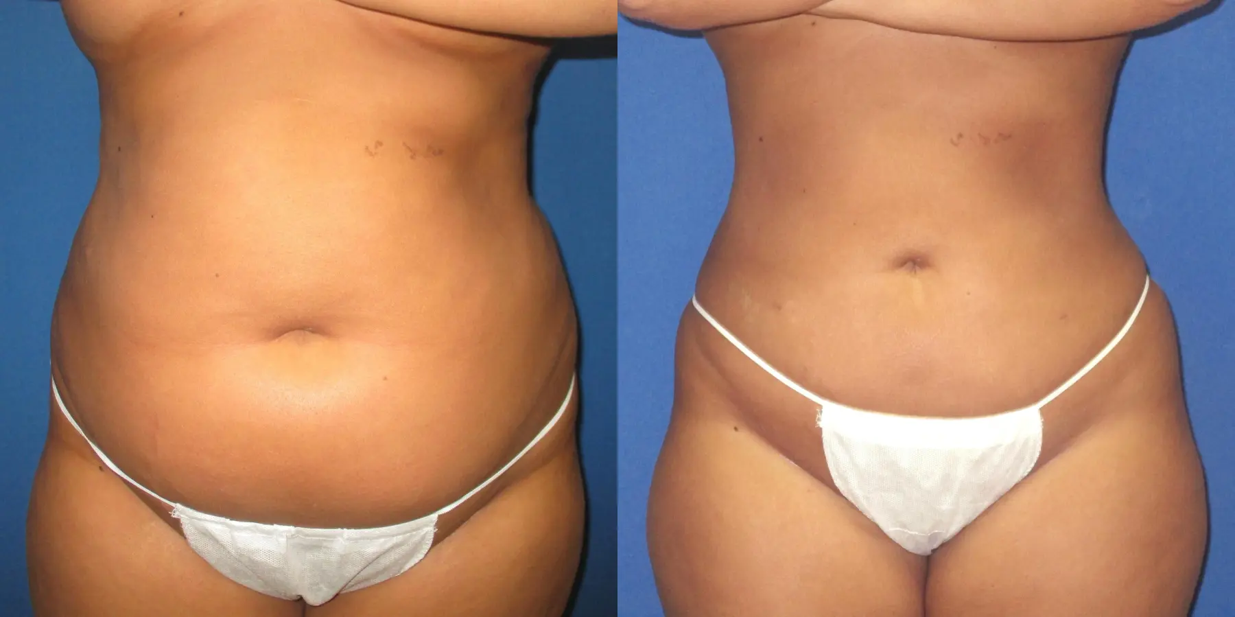Liposuction: Patient 14 - Before and After  