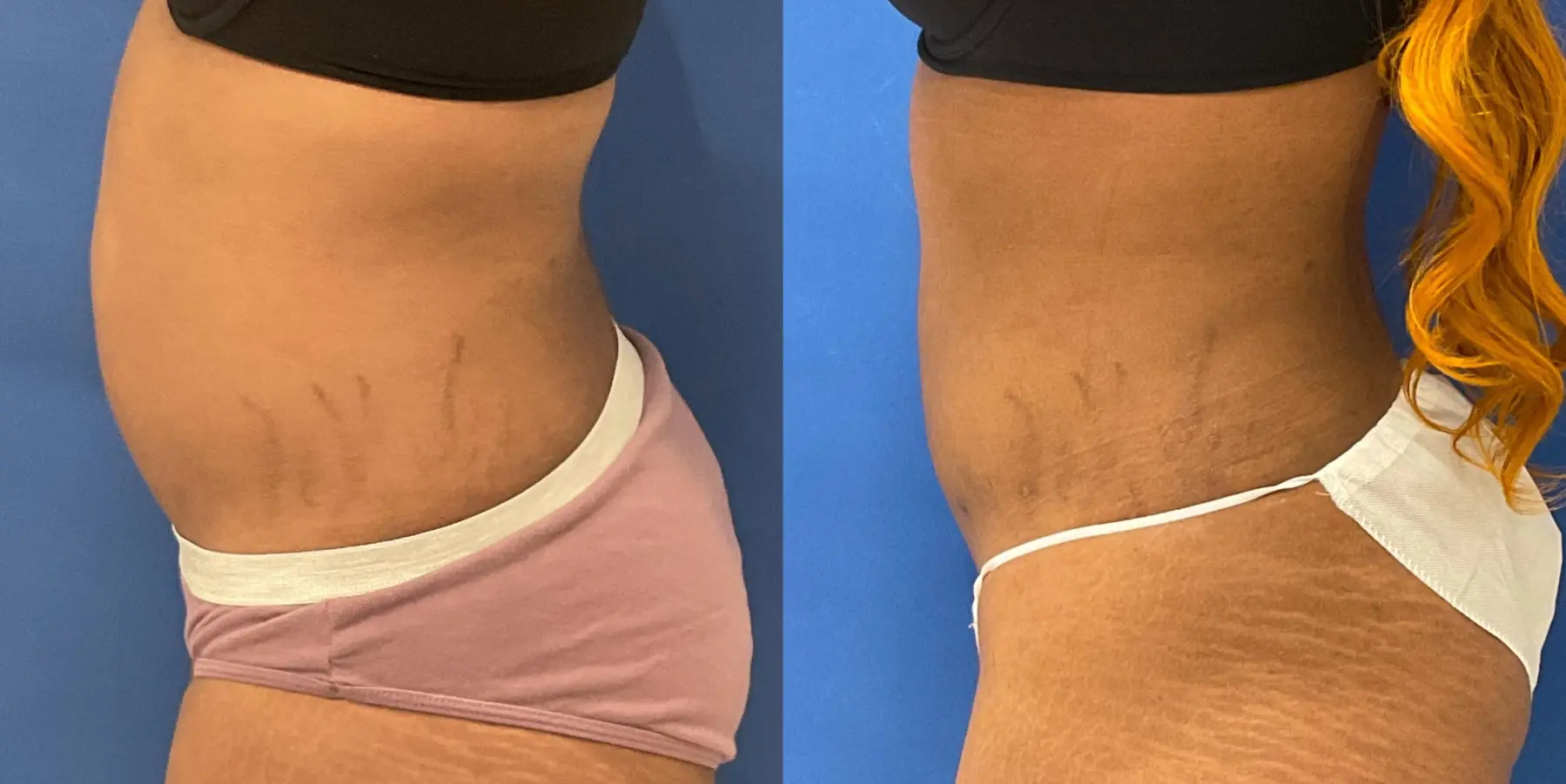 Liposuction: Patient 19 - Before and After 4