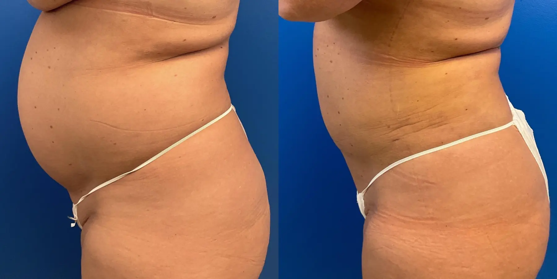 Before and after a liposuction. - Before and After 4