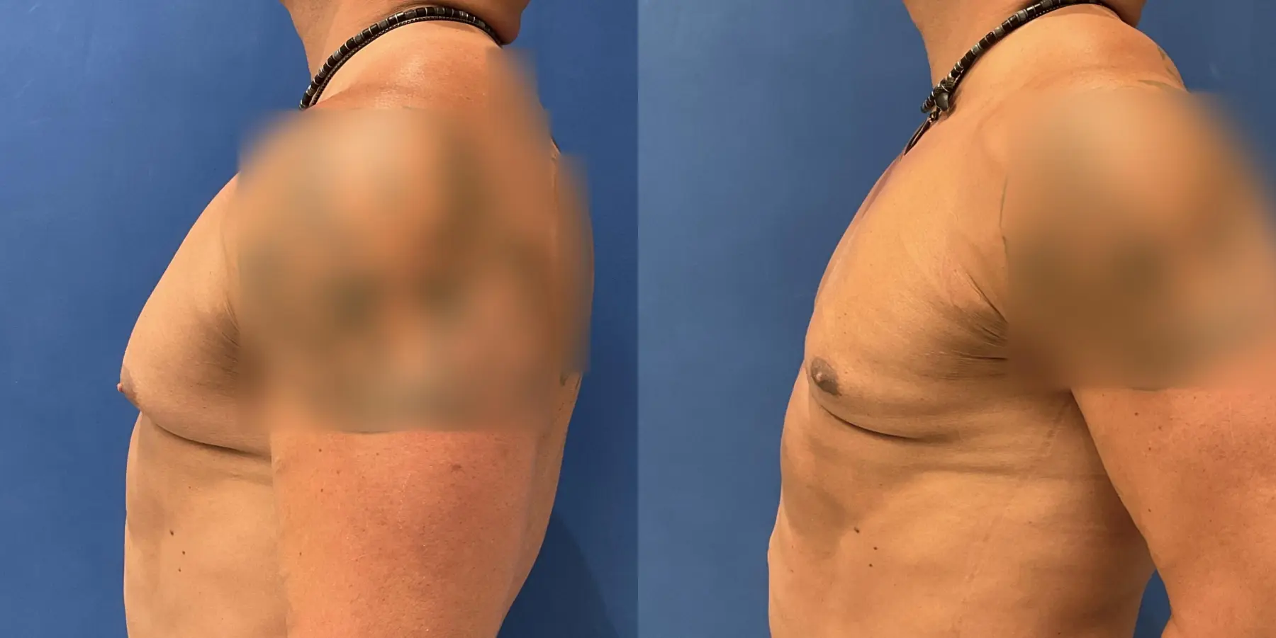 Liposuction For Men: Patient 2 - Before and After 4