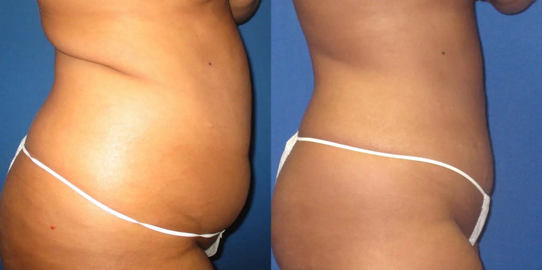 Liposuction: Patient 8 - Before and After 3