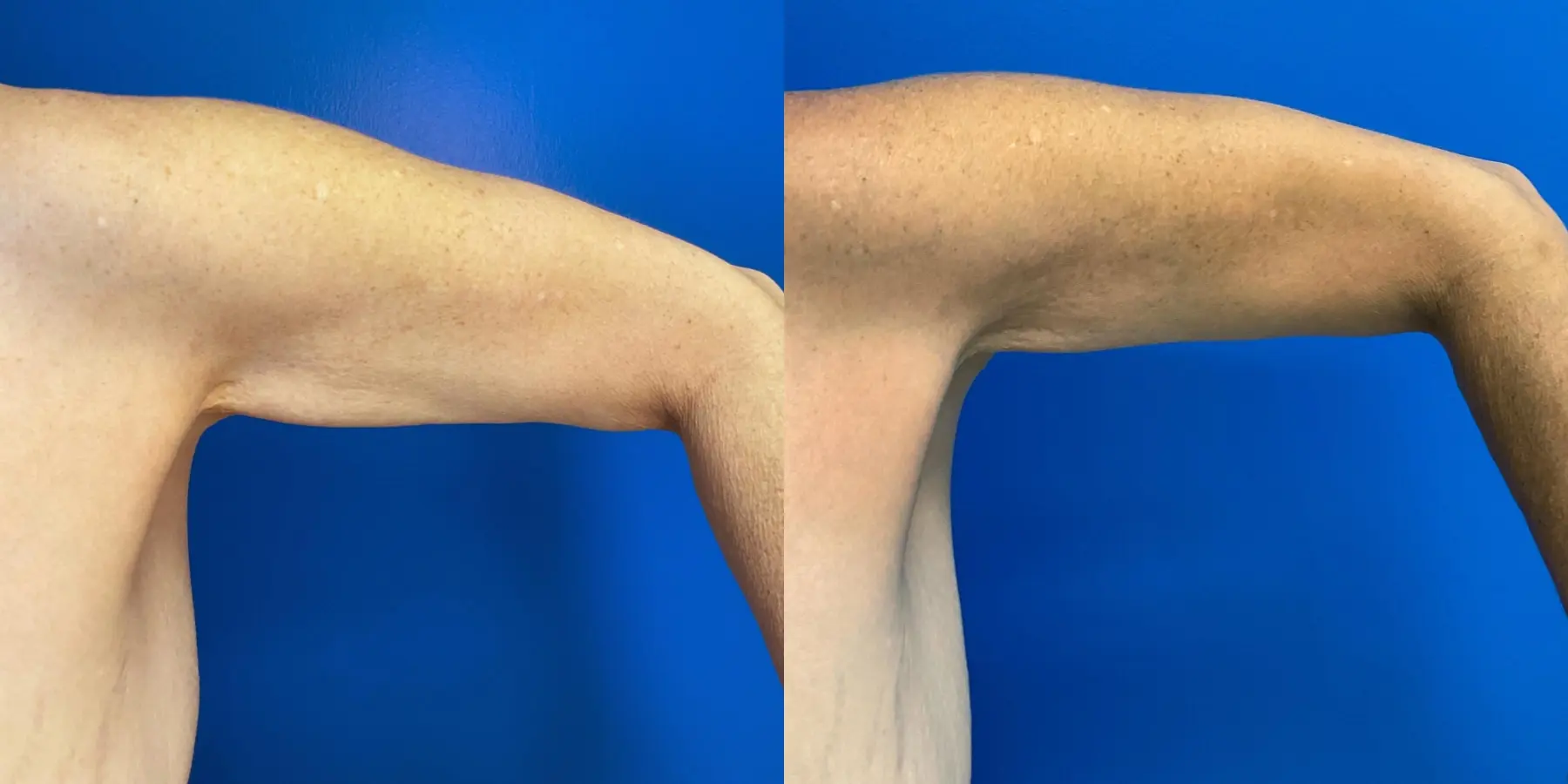 Liposuction: Patient 4 - Before and After 3