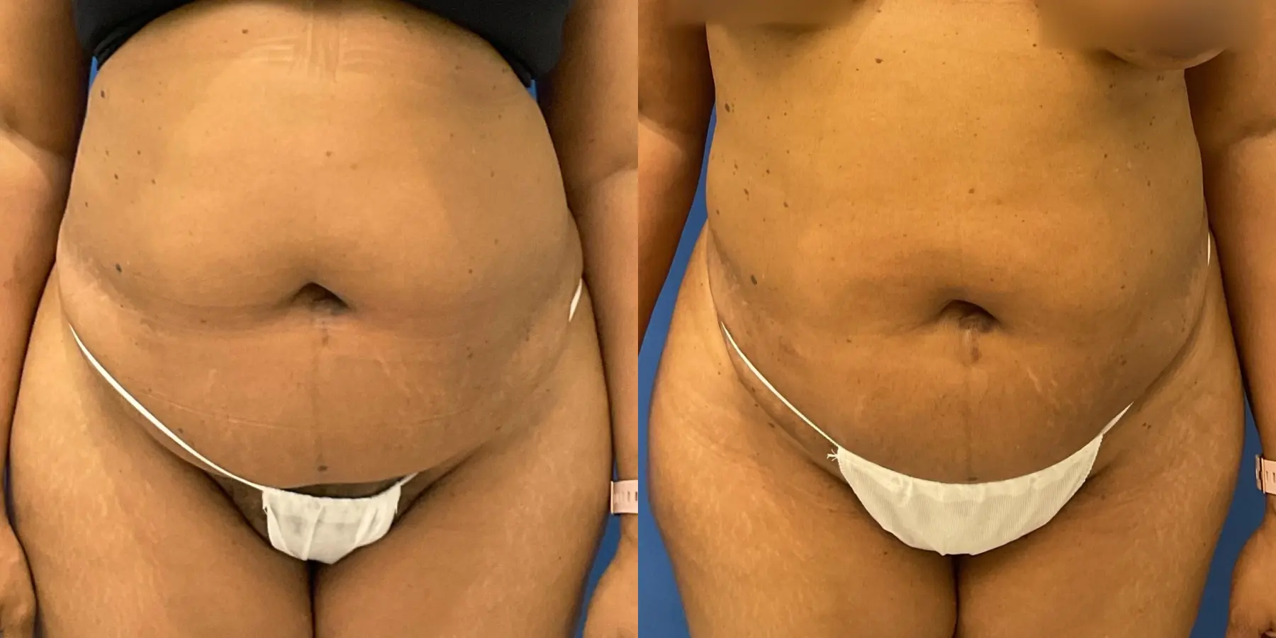 Liposuction: Patient 12 - Before and After  