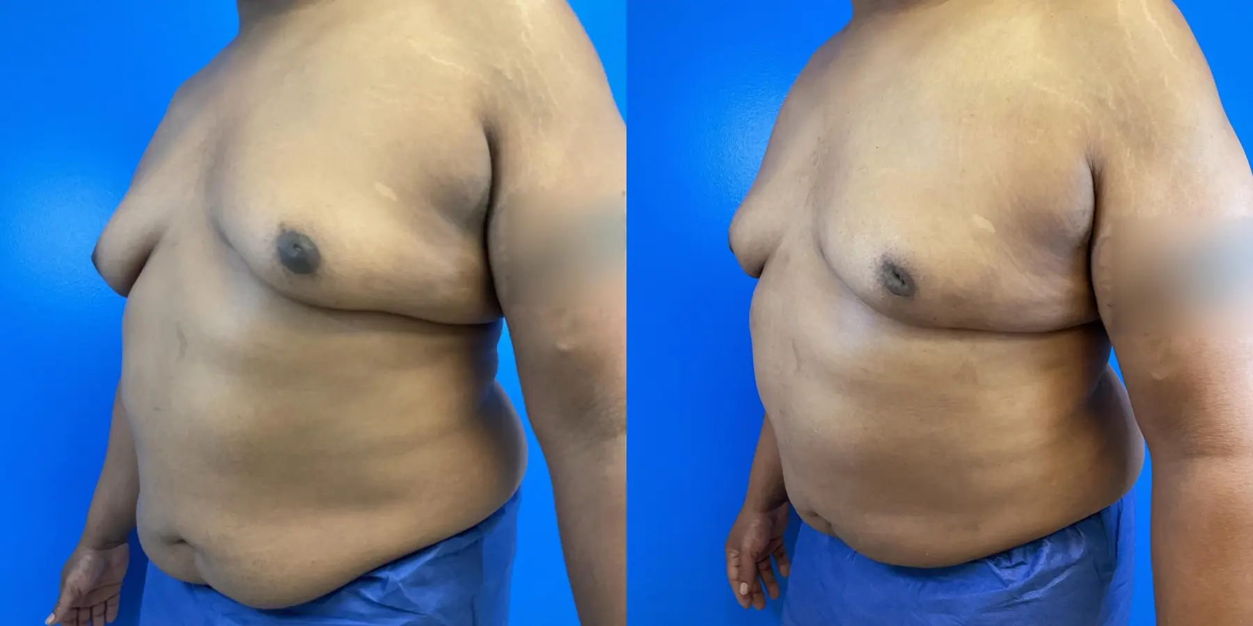 Before and after a liposuction. - Before and After 2