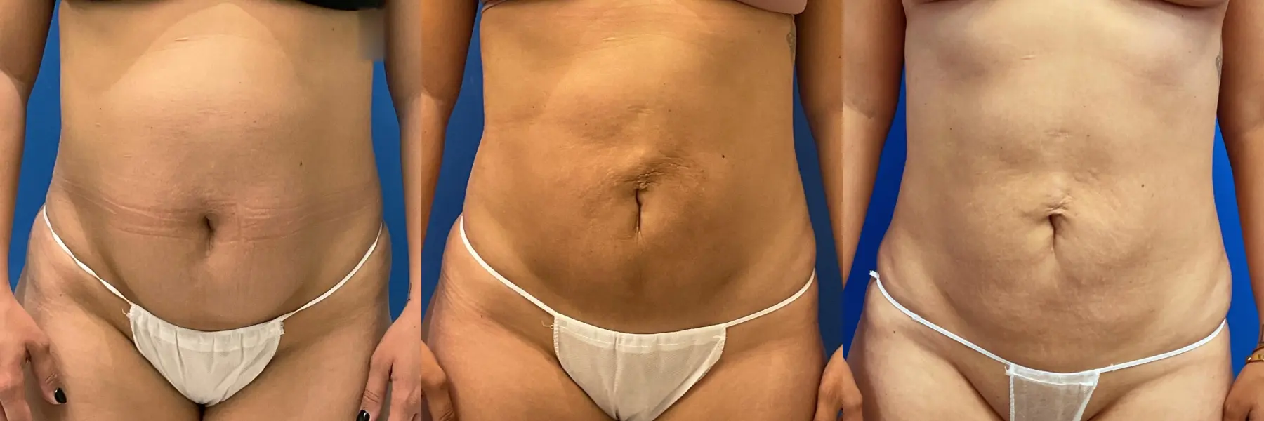 Liposuction: Patient 9 - Before and After  