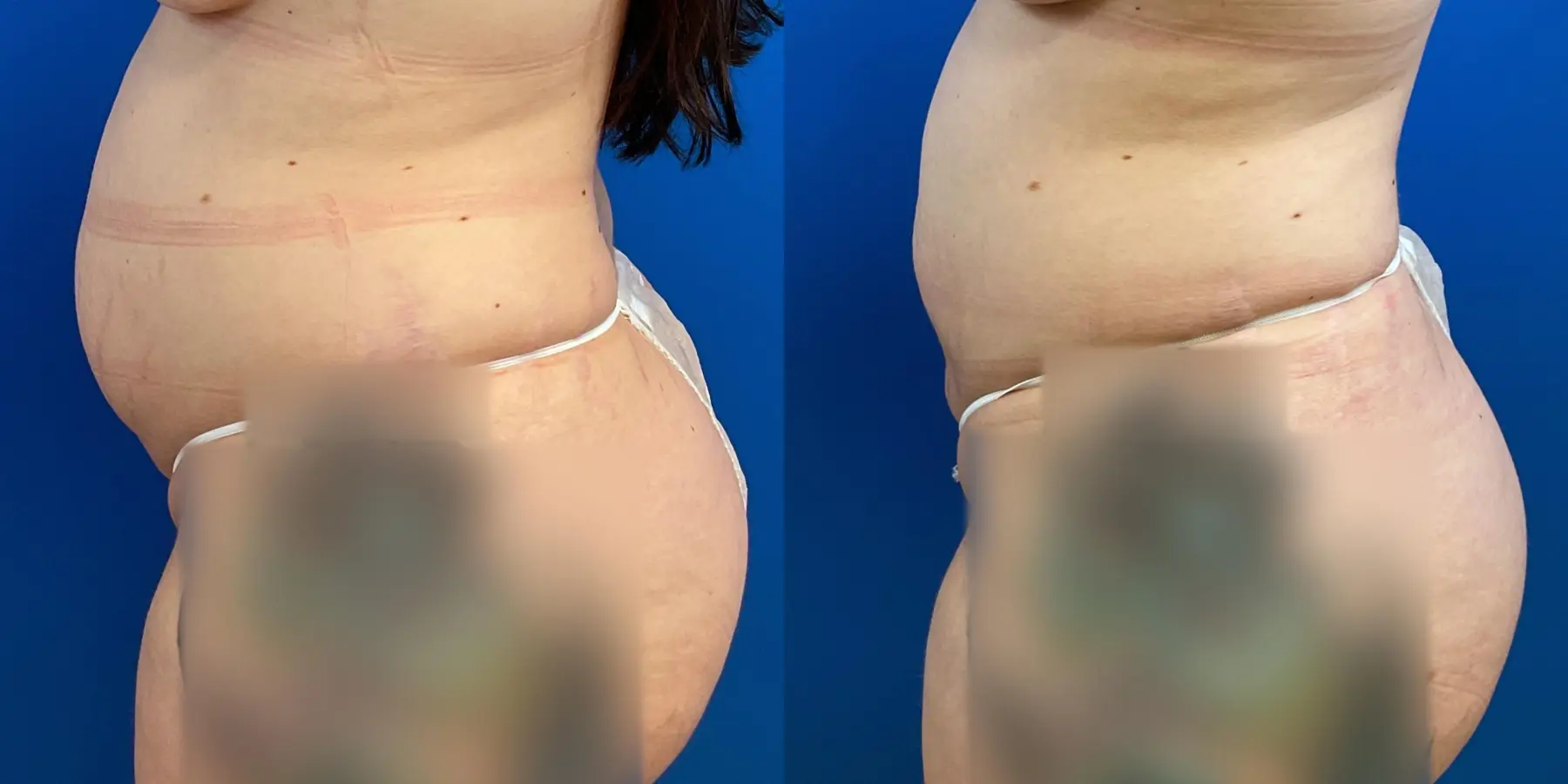 Before and after a liposuction. - Before and After 4