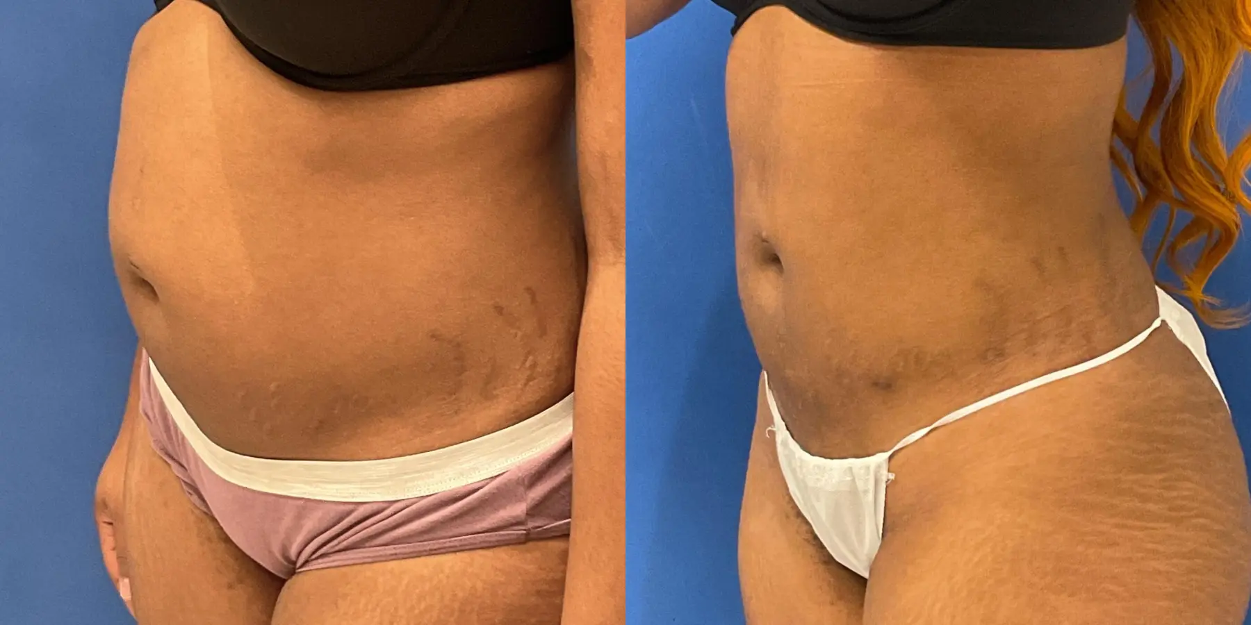 Liposuction: Patient 19 - Before and After 2