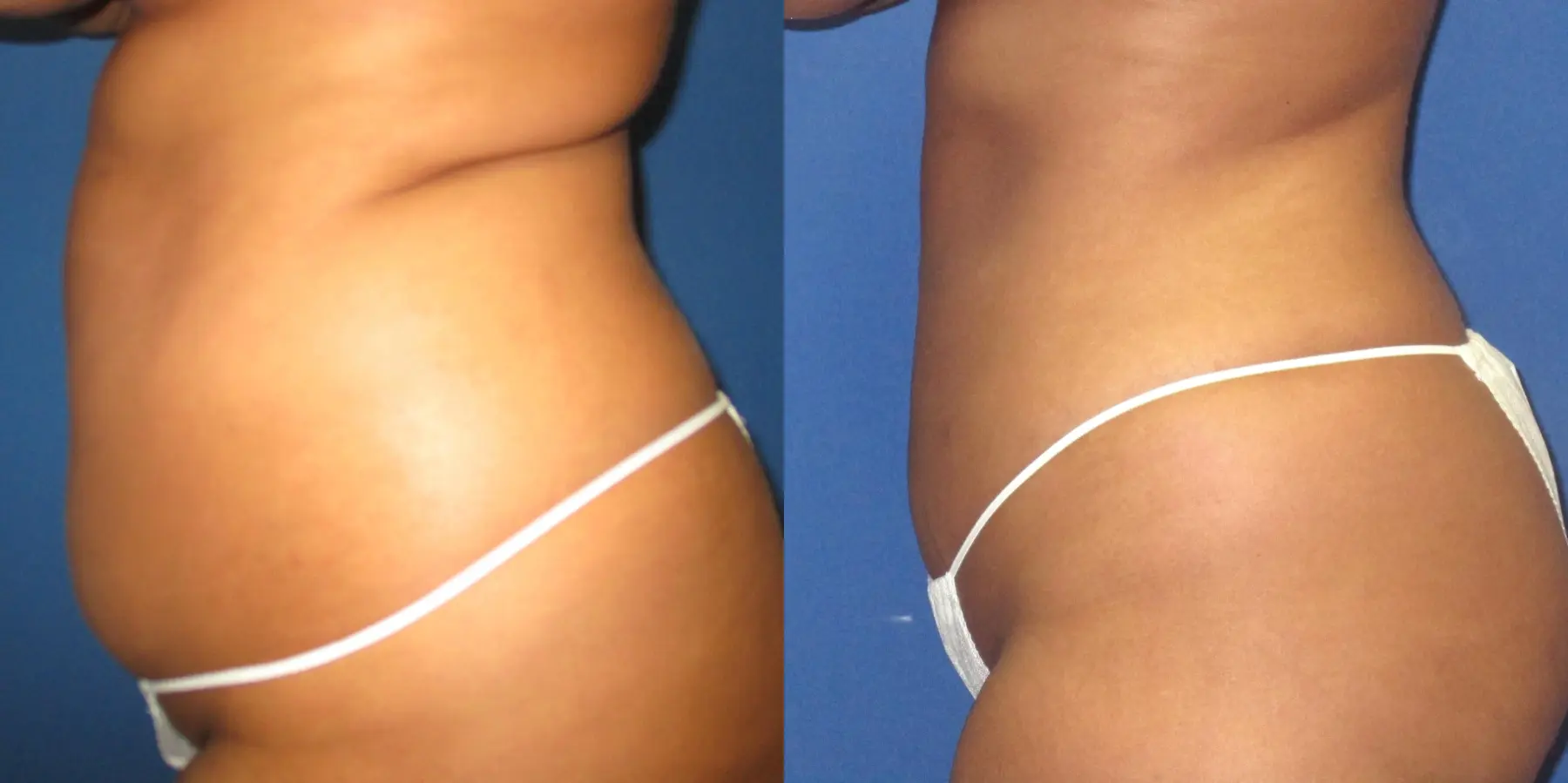 Liposuction: Patient 8 - Before and After 2