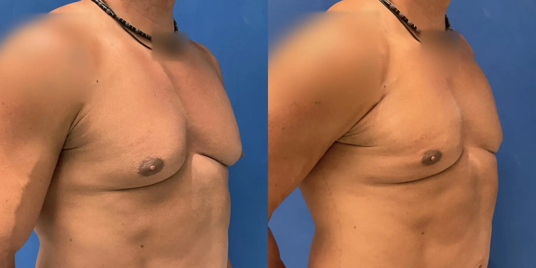 Liposuction For Men: Patient 5 - Before and After 3