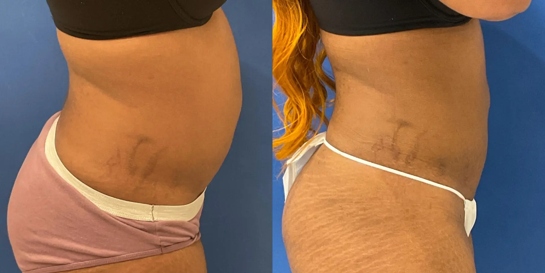 Liposuction: Patient 10 - Before and After 5