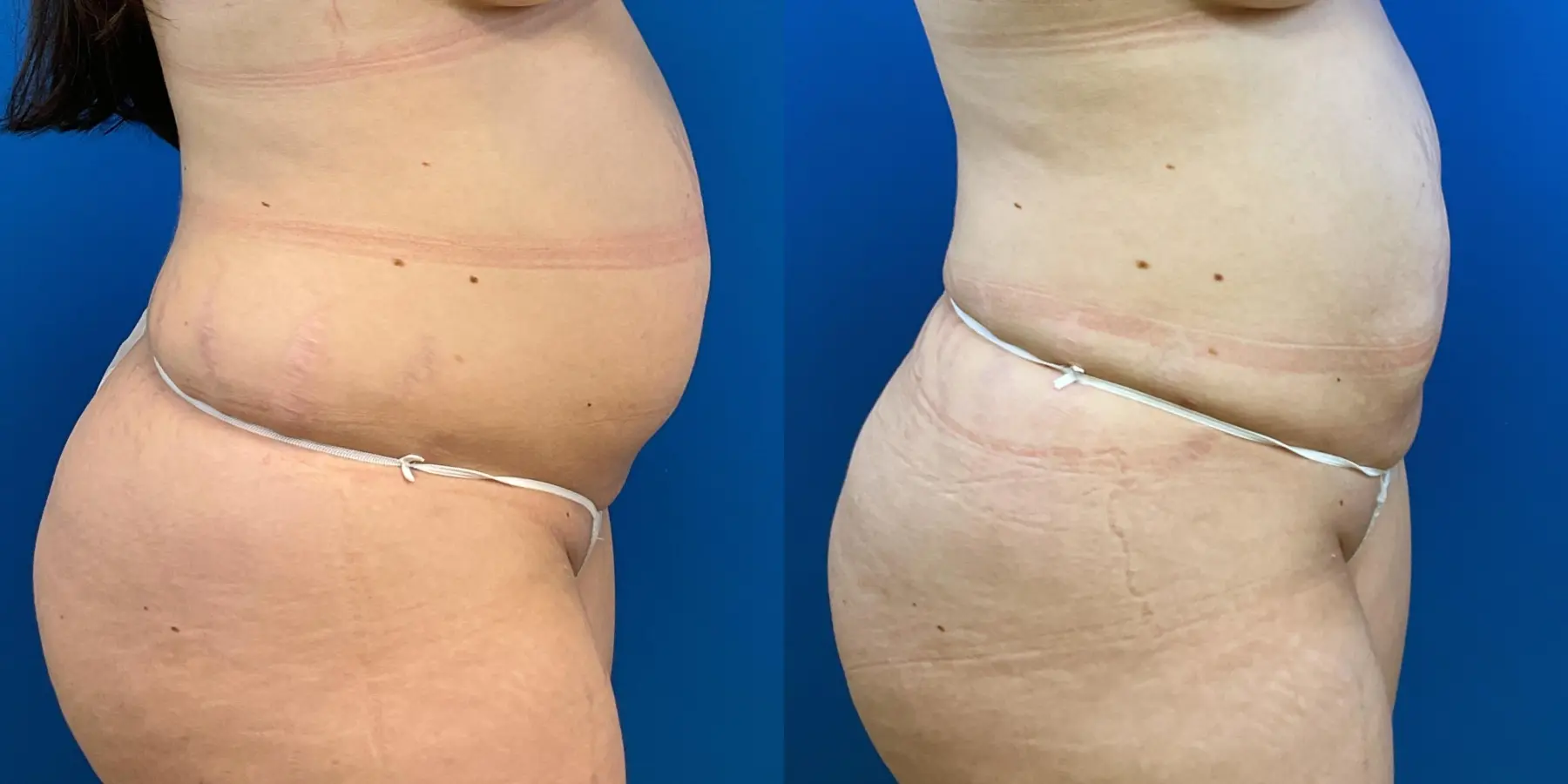 Before and after a liposuction. - Before and After 5