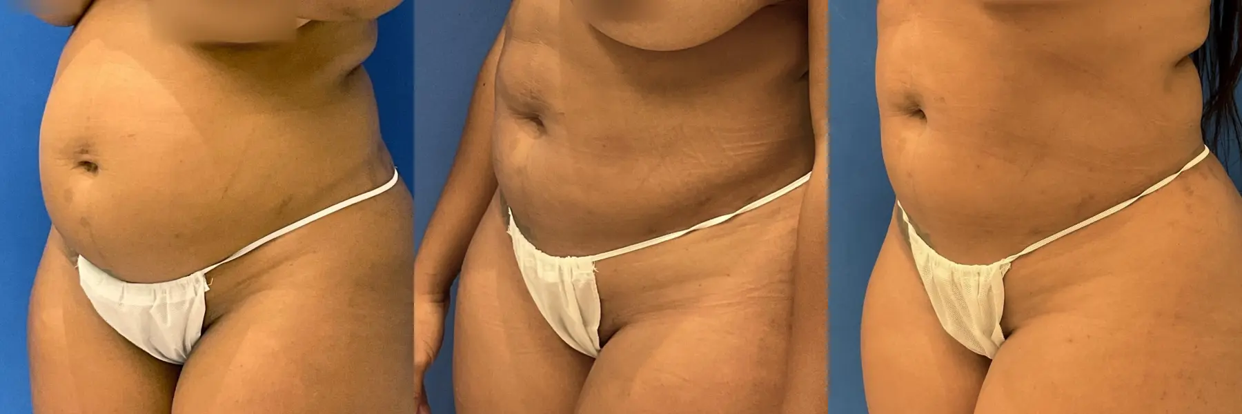 Liposuction: Patient 11 - Before and After 2