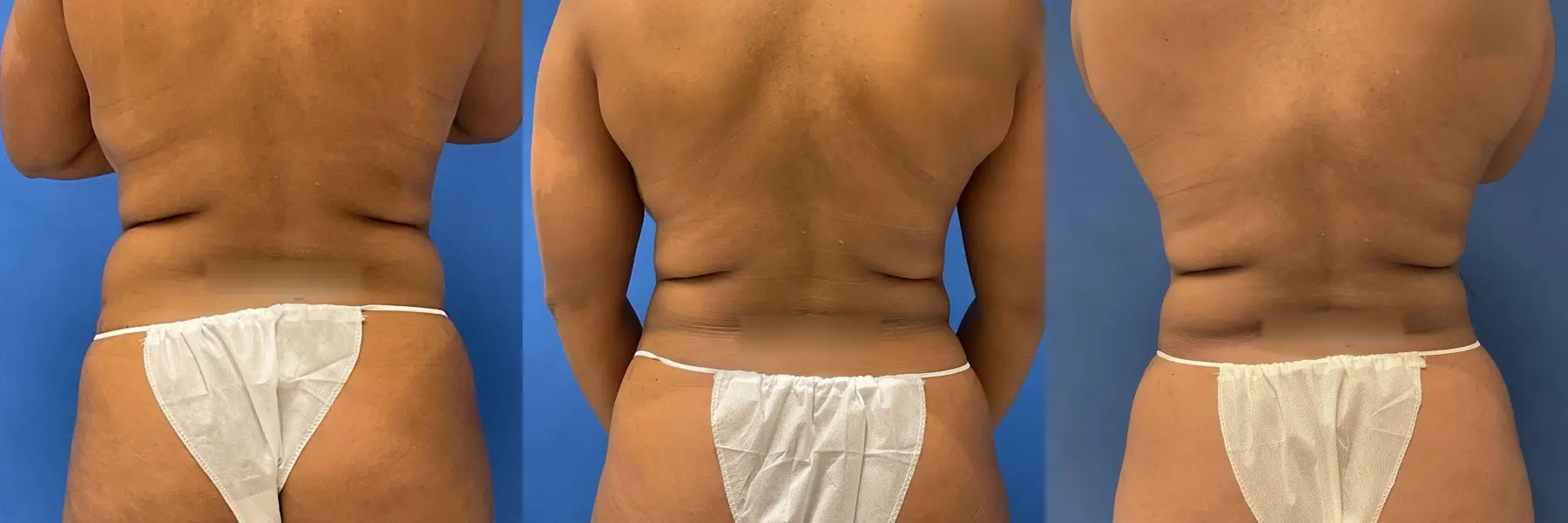 Liposuction: Patient 11 - Before and After 6