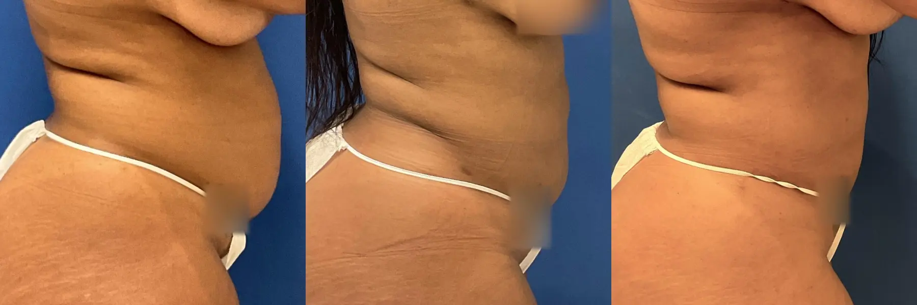 Liposuction: Patient 11 - Before and After 5