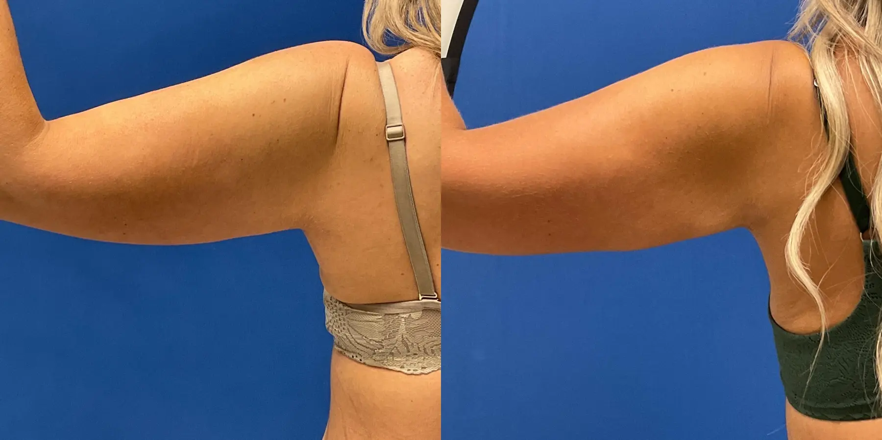 Liposuction: Patient 12 - Before and After 3