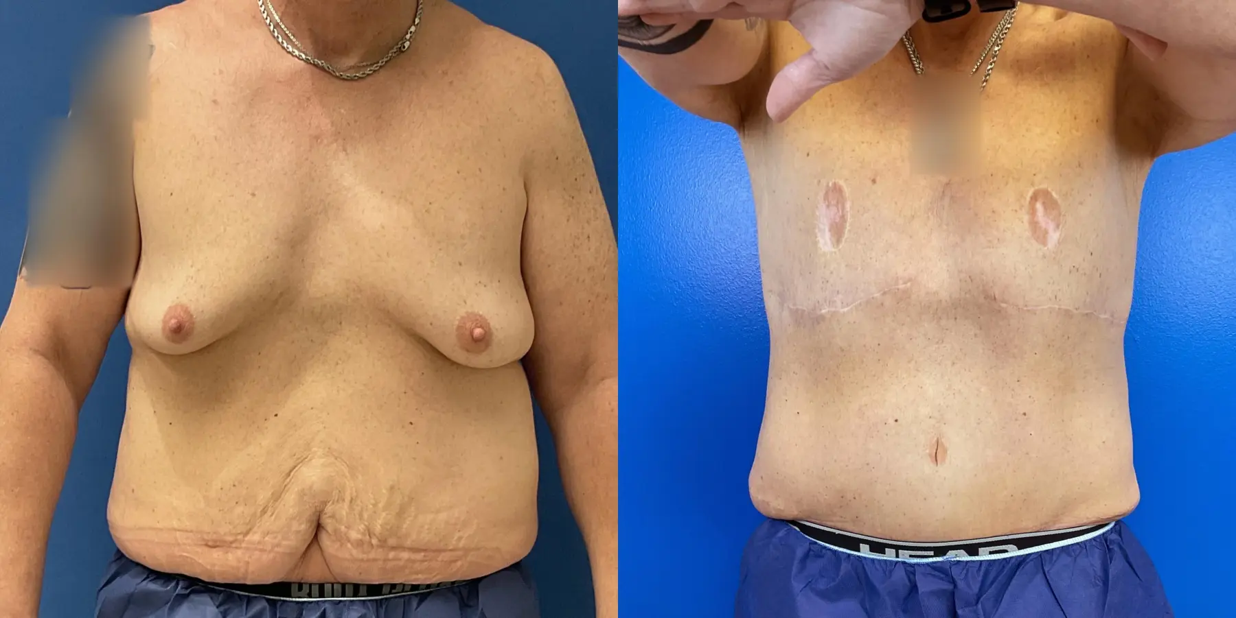 Male Breast Reduction: Patient 5 - Before and After 1