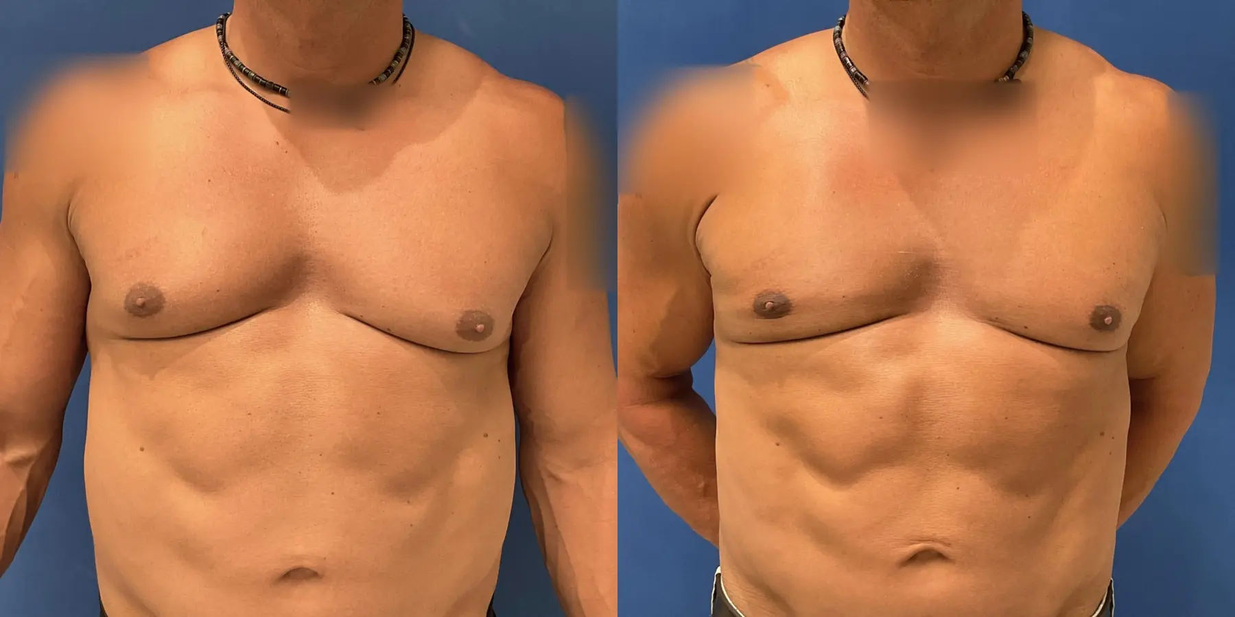 Male Breast Reduction: Patient 10 - Before and After  