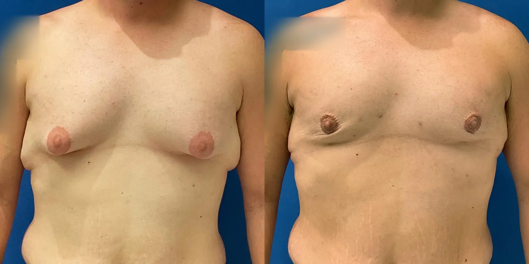 Male Breast Reduction: Patient 13 - Before and After 1