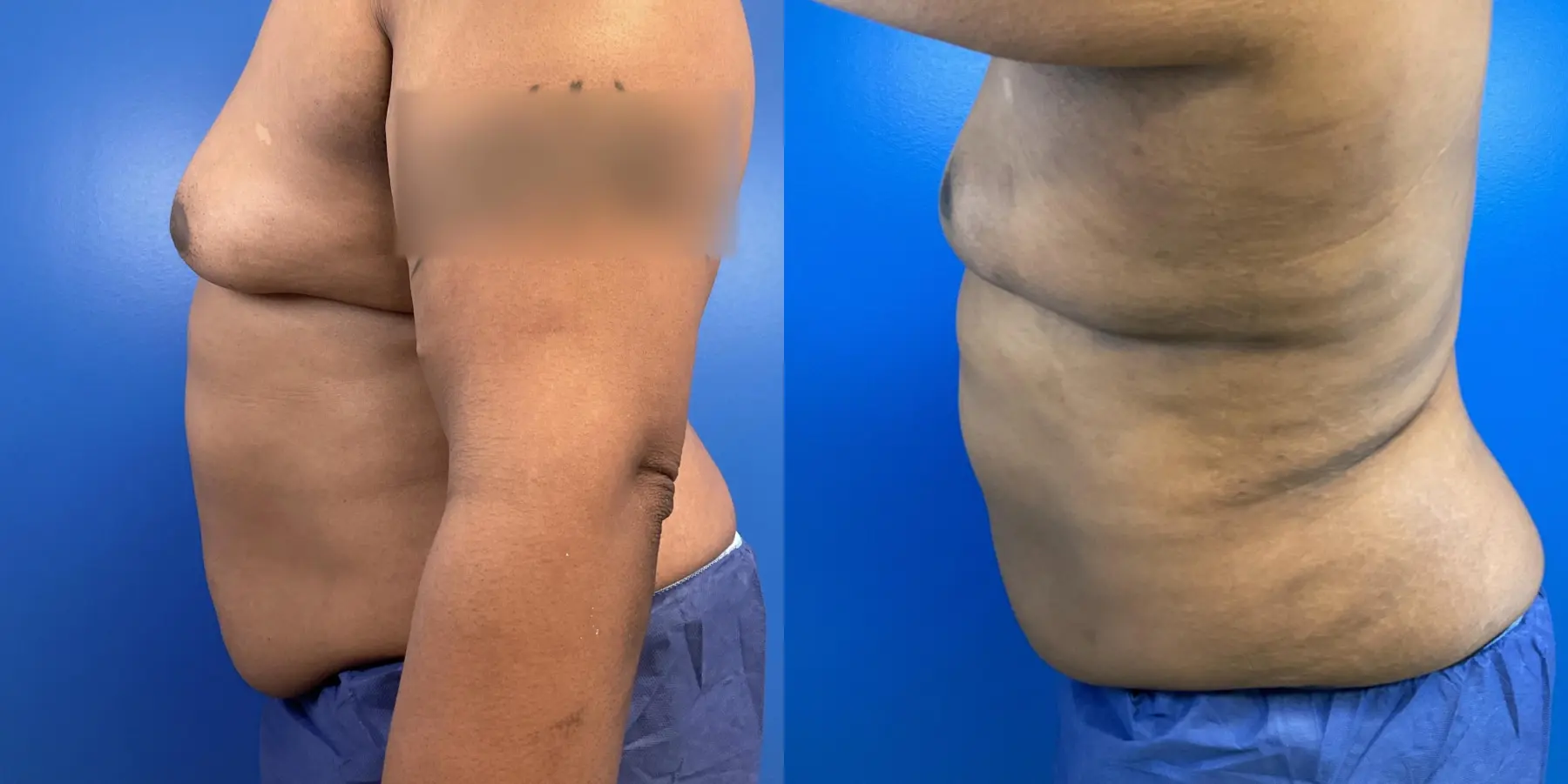 Male Breast Reduction: Patient 7 - Before and After 4