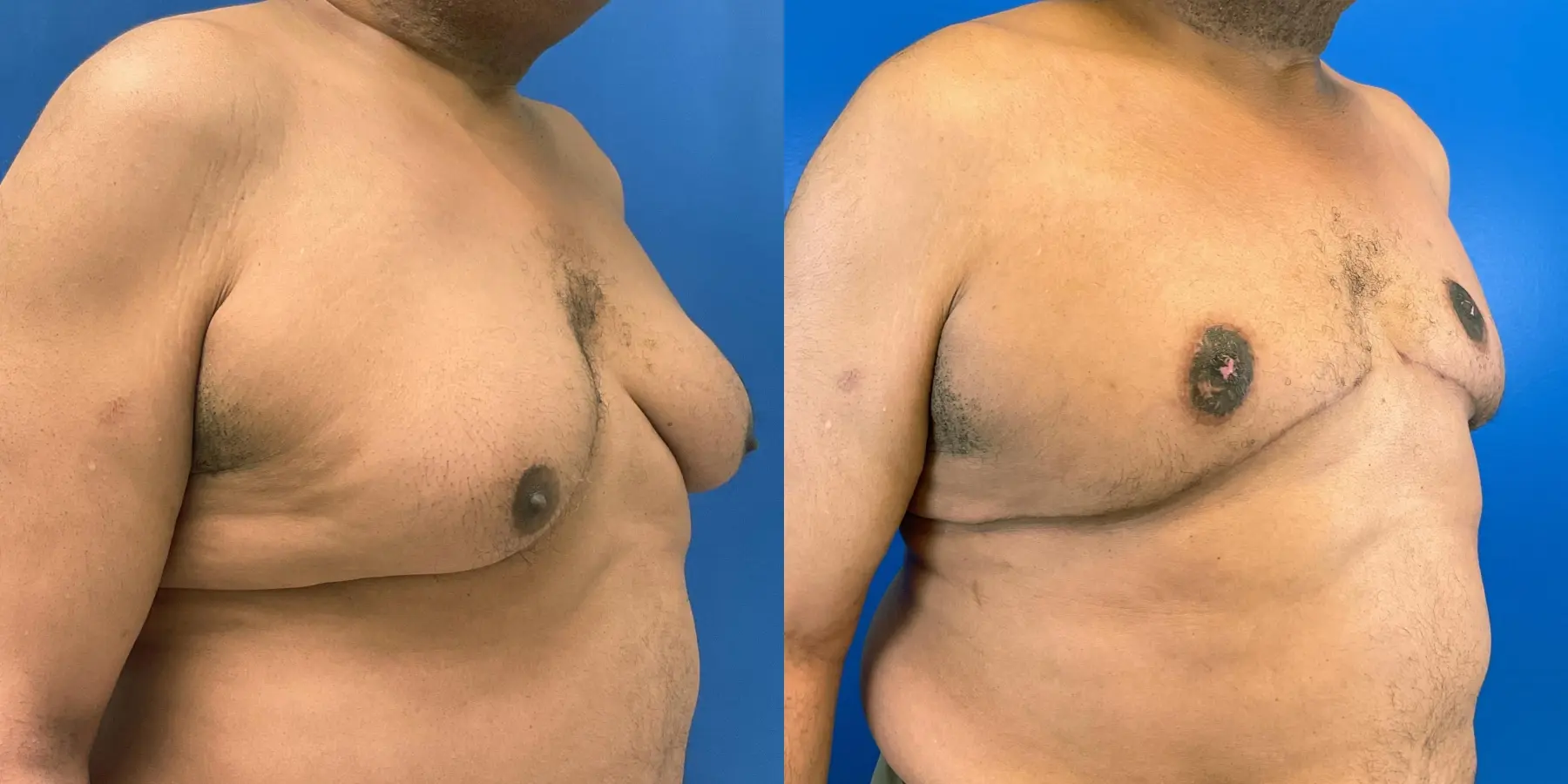 Male Breast Reduction: Patient 2 - Before and After 3