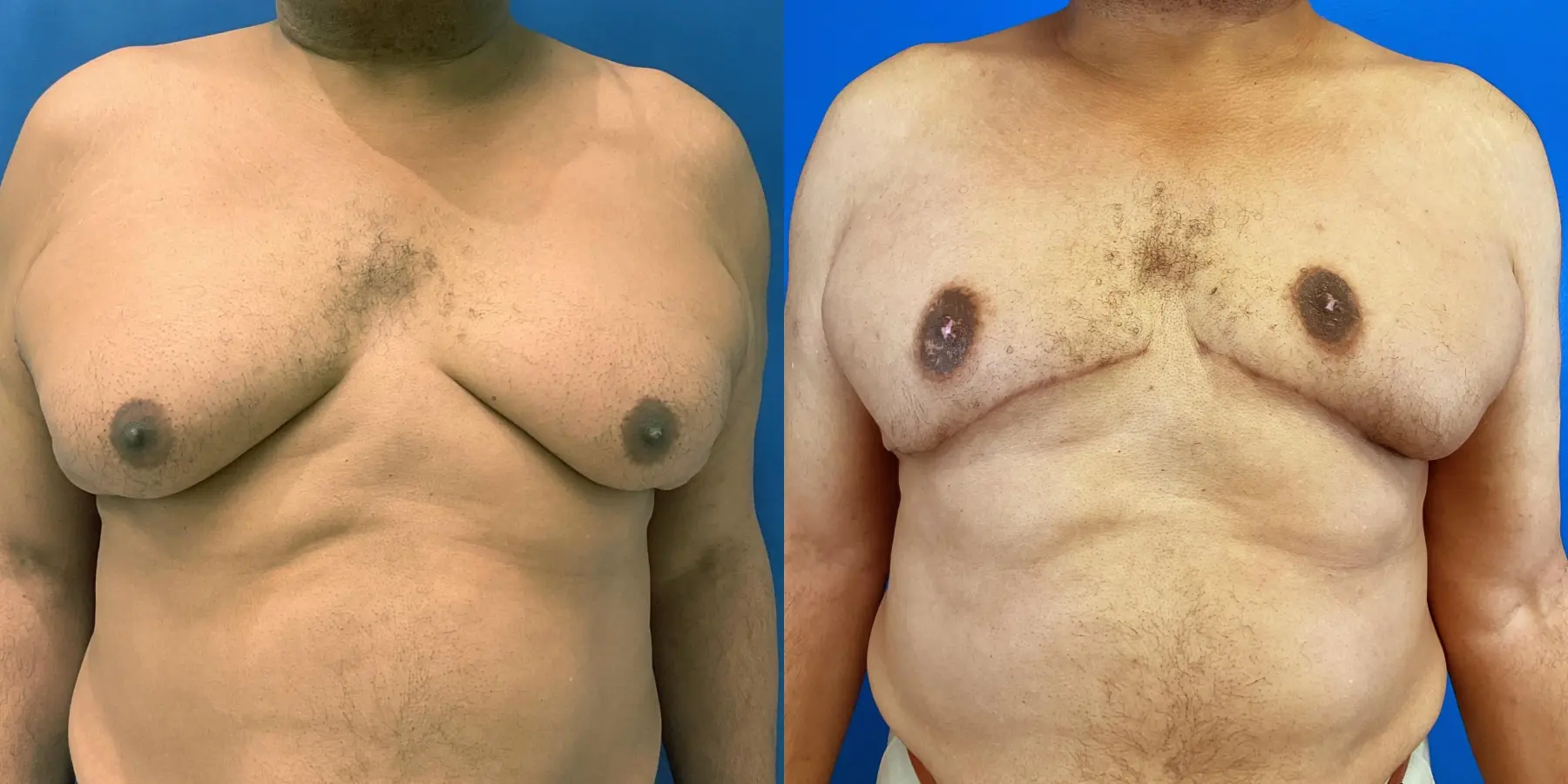 Male Breast Reduction: Patient 2 - Before and After  