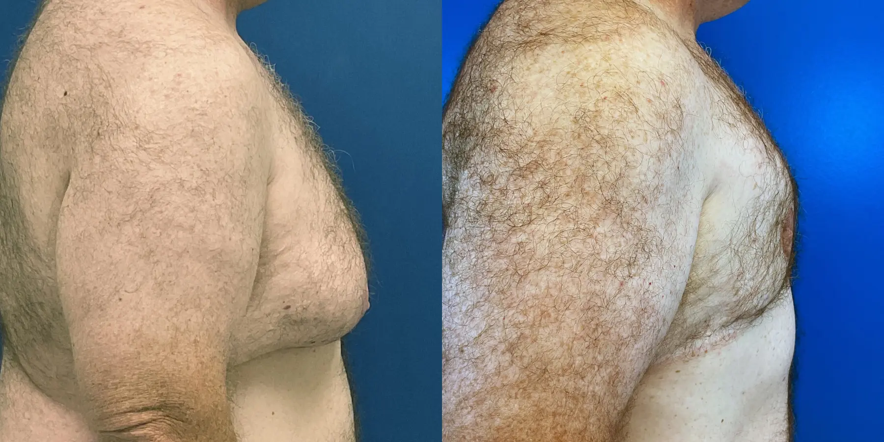 Male Breast Reduction: Patient 9 - Before and After 5