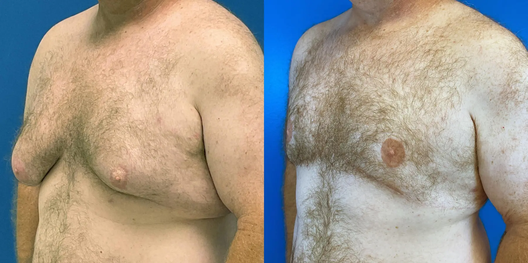 Male Breast Reduction: Patient 3 - Before and After 2