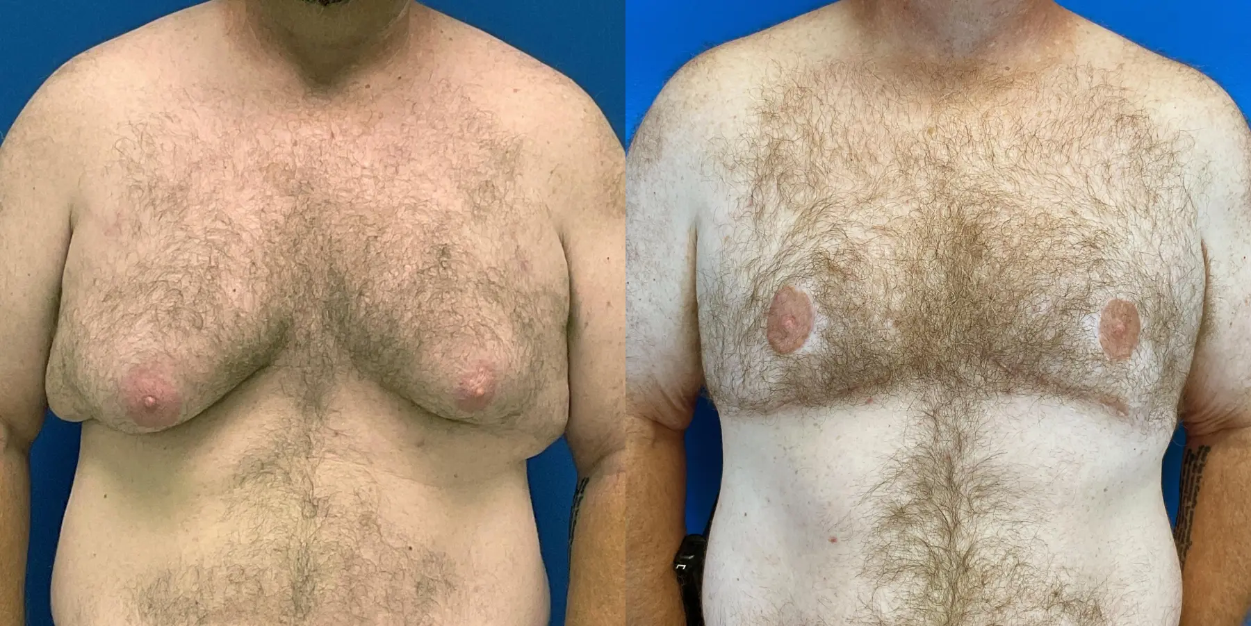 Male Breast Reduction: Patient 3 - Before and After  