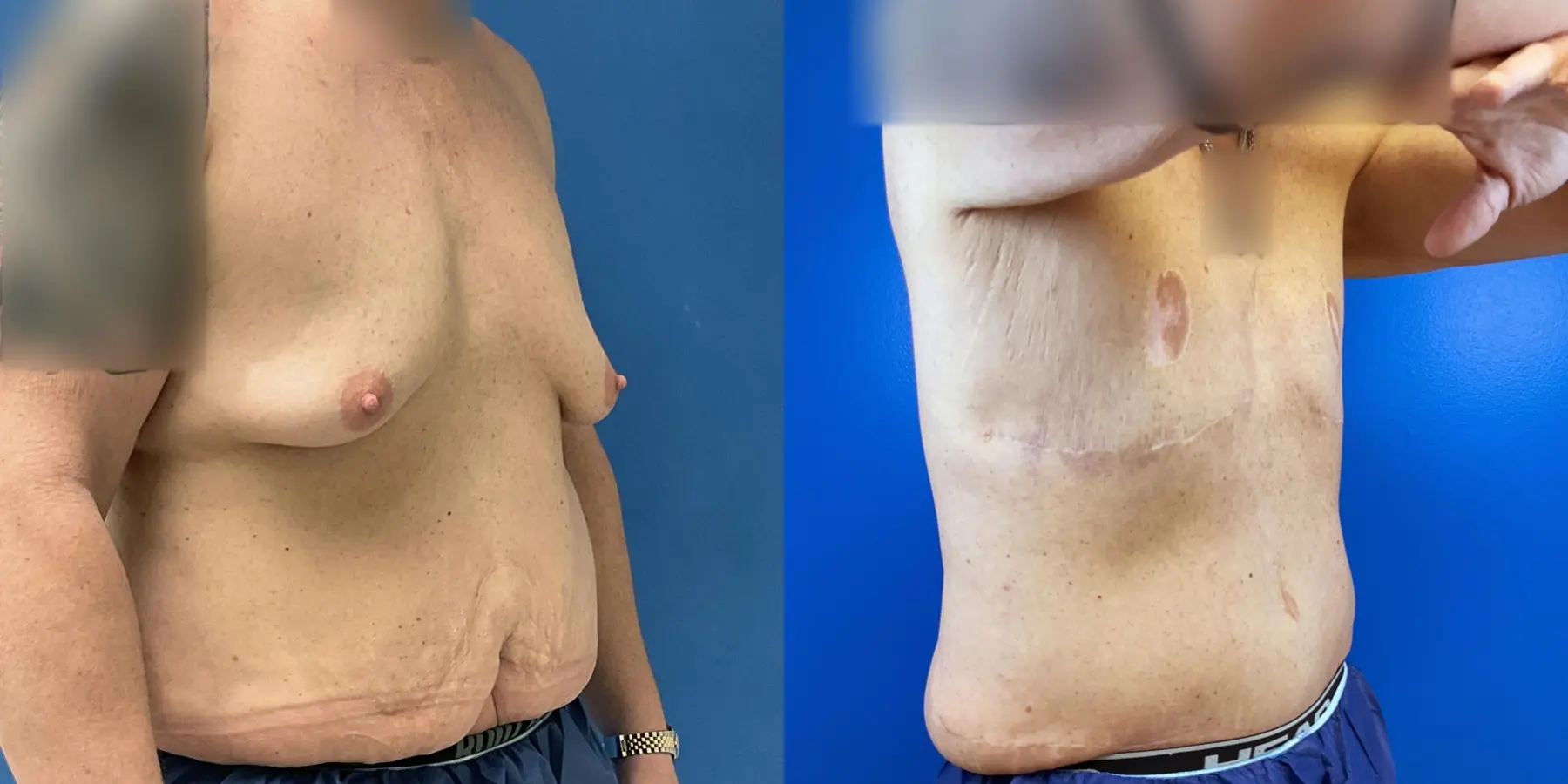 Male Breast Reduction: Patient 5 - Before and After 3