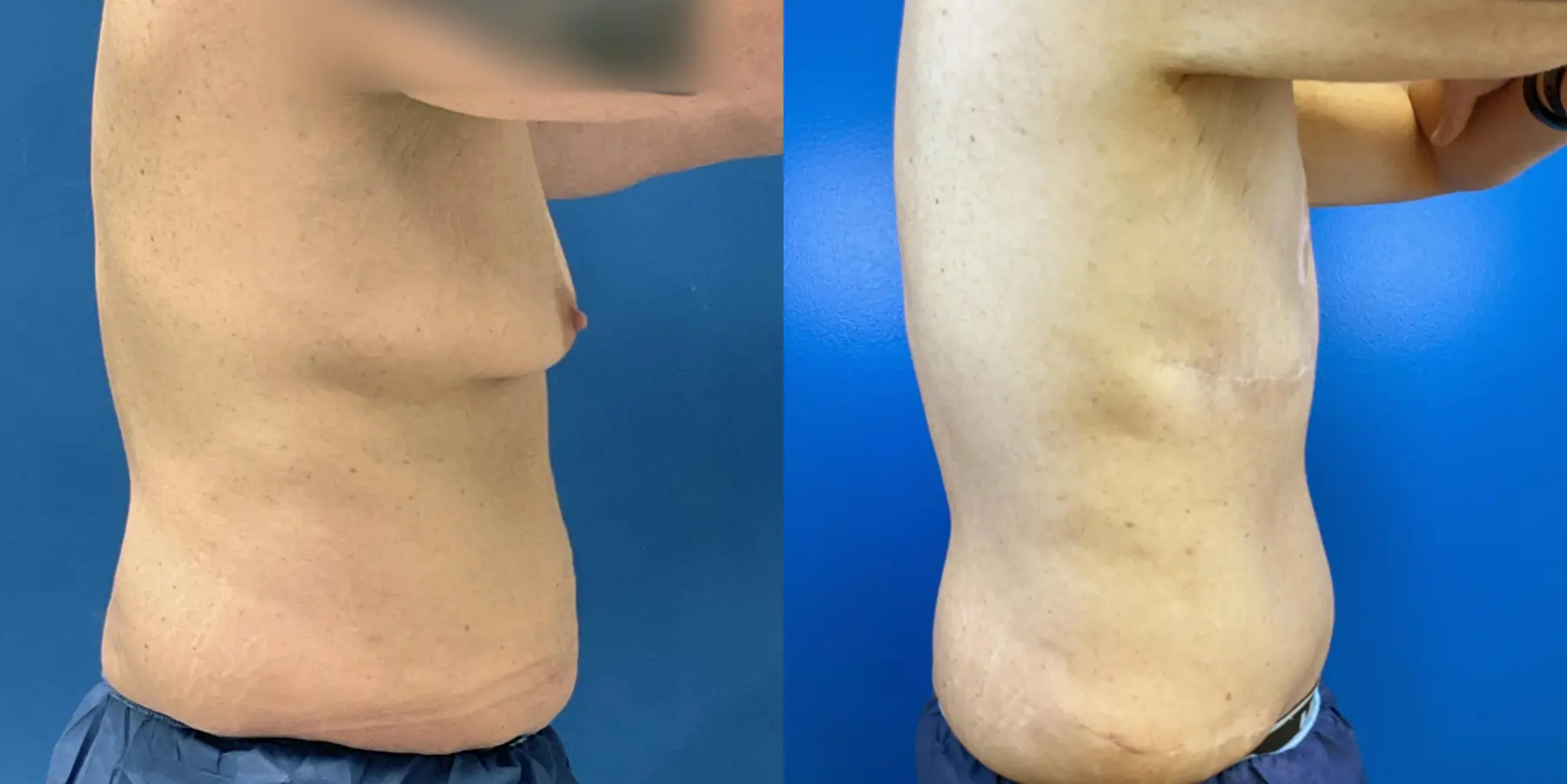 Male Breast Reduction: Patient 11 - Before and After 5